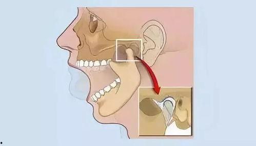颞颌关节复位视频,跟随视频轻松掌握复位方法